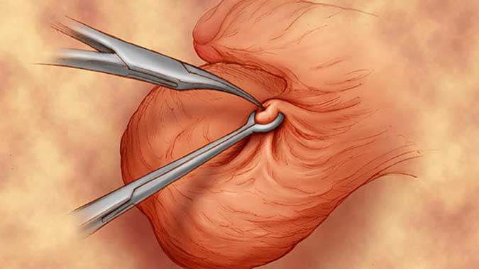 Vasectomy: What Is It and Why Is It Done?